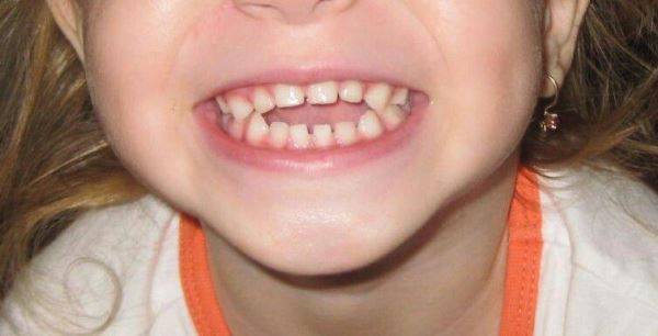 Почему у ребёнка кривые зубы